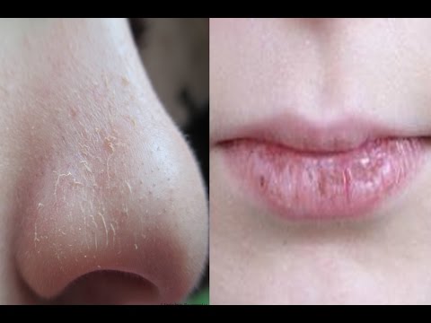 Kůže na obličeji je suchá a peeling - co dělat, důvody, léčba